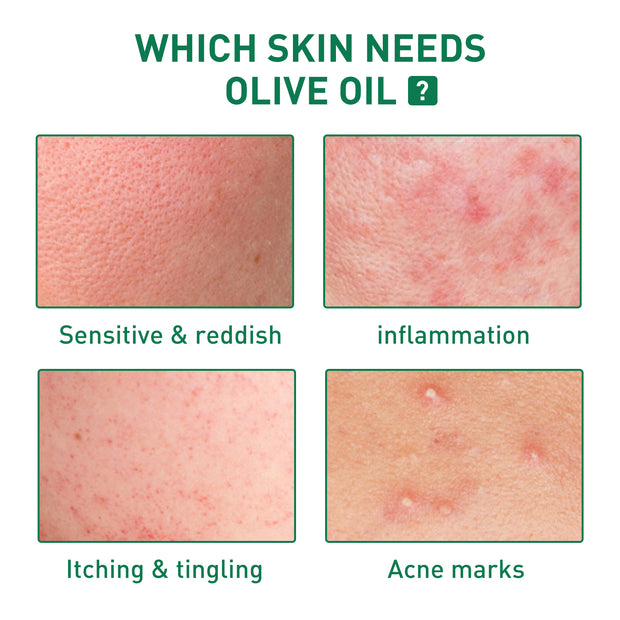 Tea Tree Oil Acne Serum, Remove Acne, Clear Acne, Repair Skin, Lighten Acne Printing Face Essence